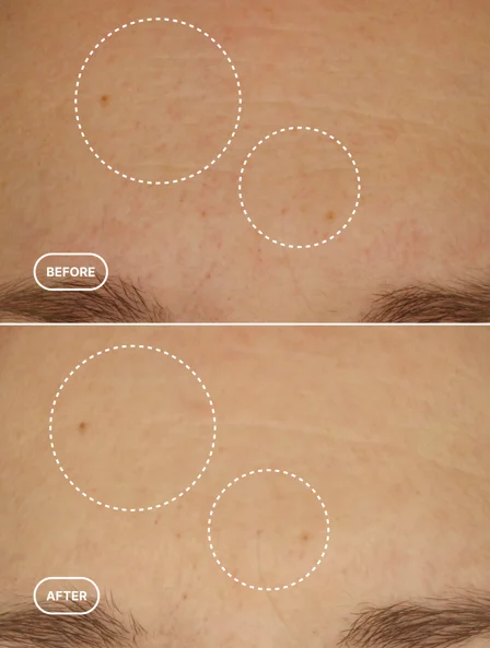 Skincare results 