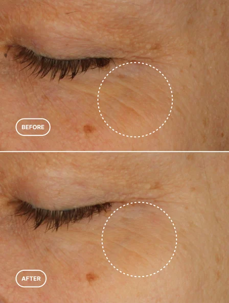 Skincare results 